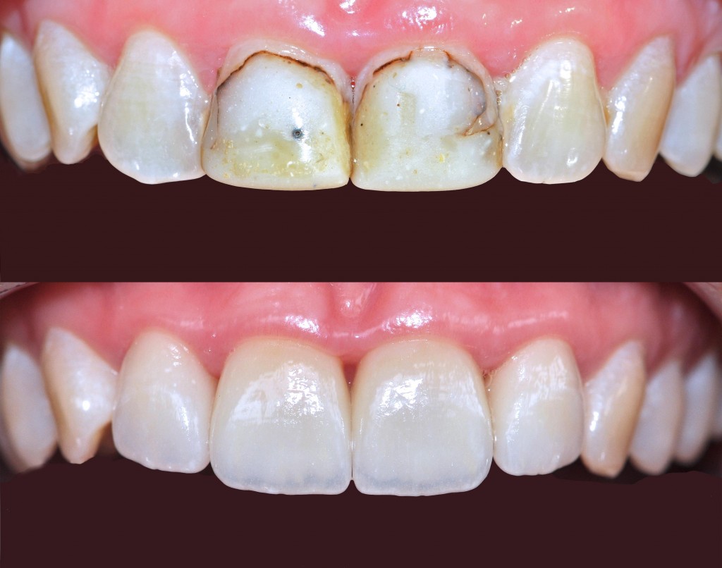 Zahnklinik-in-der-Turkei-Porzellan-Veneer-Behandlung